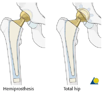 Gambar 7. Perbedaan hemiarthroplasty dengan total hip arthroplasty 