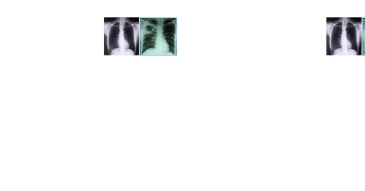 Gambar 10. Gambaran TB aktif cavitas dikelilingi bayangan opak berawan