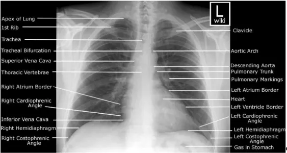 Gambar 2.8 Gambaran Radiografi Thorax 