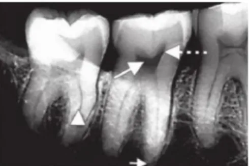 Gambar  2.6  Pada  gambaran  radiografi  terlihat  radiolusen  (tanda  panah).  (From  Anil  GG,  Savita  AG: 