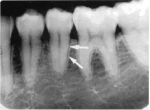 Gambar  2.7  Lamina    dura  (panah  putih)  tampak  sebagai lapisan tipis yang radiopak yang mengelilingi  akar  gigi  pada  foto  rontgen