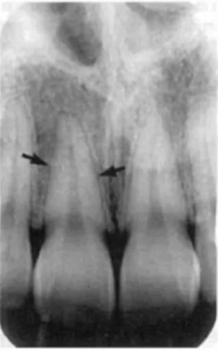 Gambar  2.9  Space  ligament  periodontal  (panah  hitam)  terlihat  radiolusensi  tipis anatara akar gigi dengan  lamina dura pada rontgen  foto