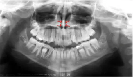 Gambar  2.11  Gambaran  radiografi  dari  septum  nasal  (panah  merah)  tampak  radiopak