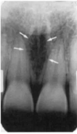 Gambar  2.12  foramen  insisivus  tampak  seperti  lingkaran  yang  radiolusen  (panah putih) yang berada di antara akar insisivus sentral