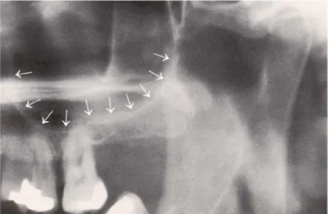 Gambar  2.14  Gambaran  radiografi  sinus  maksilaris  tampak  radiolusen,  dasar  sinus  (panah  putih)  tampak radiopak