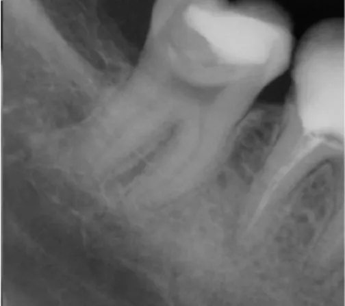 Gambar 1. Menunjukkan gigi molar dua dengan karies sekunder dan gigi molar  pertama dengan pengisian yang kurang padat