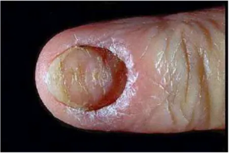 Gambar 10. Paronychia kronis.
