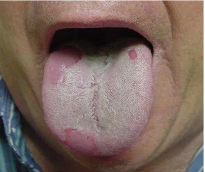 Gambar 3.Geographic tongue pada lidah orang dewasa 