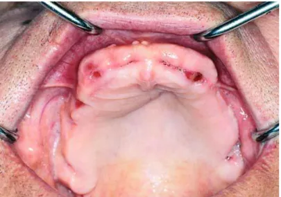 Gambar 4. Supraerupsi pada gigi rahang atas. Indikasi untuk alveoplasti setelah pencabutan 
