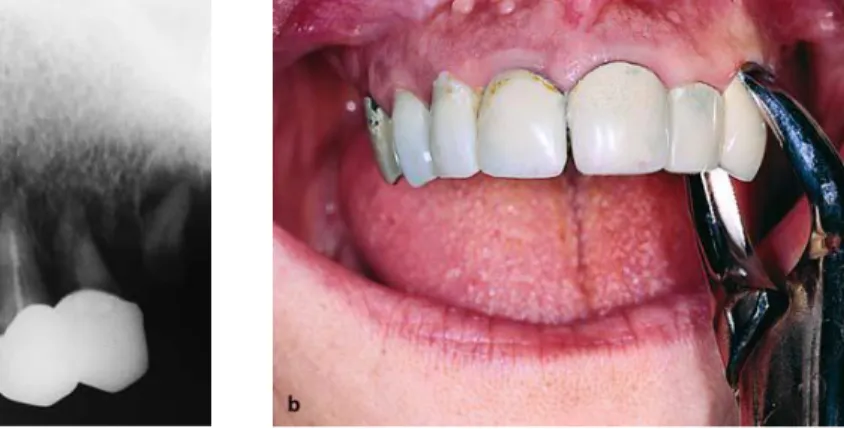 Gambar 5. Bedah alveoplasti setelah pencabutan beberapa gigi. (a) Gambaran radiologi gigi rahang  atas,  pada  tulang  alveolar  perlu  dilakukan  penghalusan