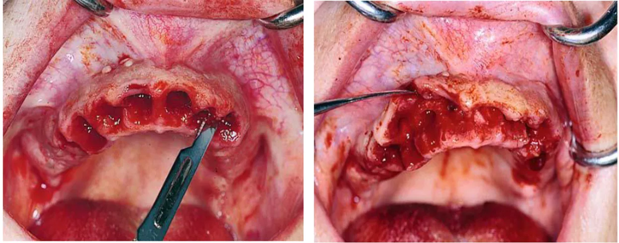 Gambar 7. (a) Insisi sepanjang alveolar ridge untuk memotong papilla interdental pada gingival