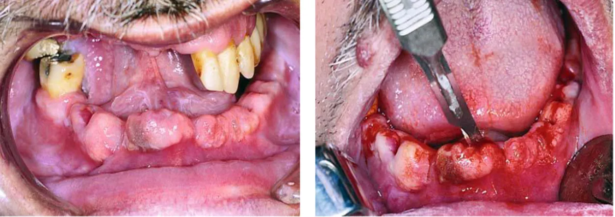 Gambar 12. (a) Tulang yang tidak rata pada edentulous alveolar ridge setelah pencabutan gigi