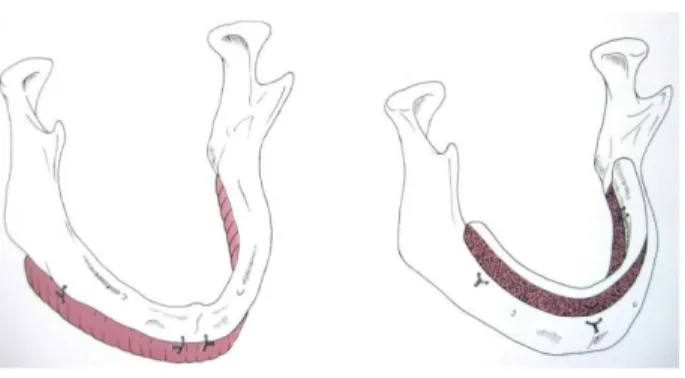 Gambar 18. Peninggian tulang alveolar dengan pencangkokan tulang autogenous. 