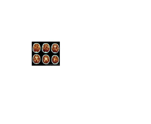Gambar 3: gambaran EEG pasien Alzheimer 