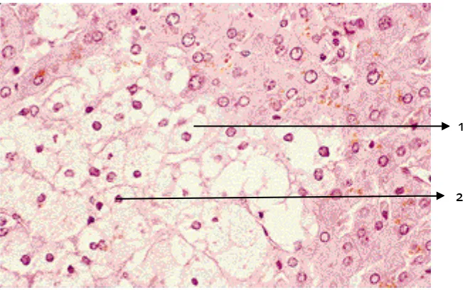 Gambar 6. Pembengkakan sel disertai vakuolisasi; Ket.: 1. Sel yang mengalami vakuolisasi, 2