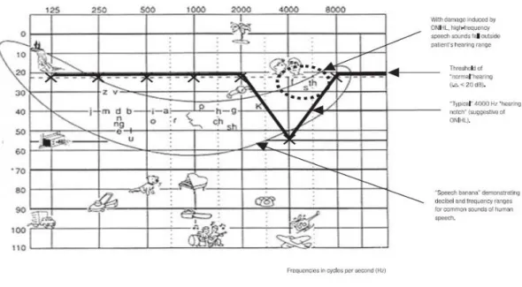 Gambar  2.3  Audiogram  standar  dengan  “speech  banana”  yang  menggambarkan pola ciri khas GPAB pada  pekerja  di frekuensi  4000 Hz  (Kurmis &amp; Apps, 2007)