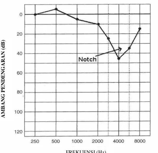 Gambar 2.4. Adanya takik/ notch pada frekuensi tinggi (4000 Hz) di Audiogram,  merupakan tanda patognomik NIHL (dikutip dari Coles, Lutman dan Buffin,   2000) 