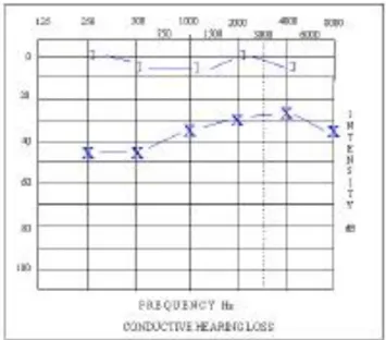 Gambar 4. Audiogram tuli konduktif  10 