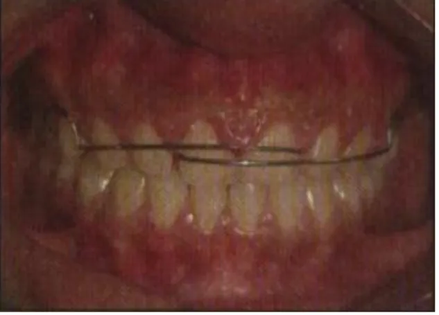 Gambar 8. Split Labial Bow 
