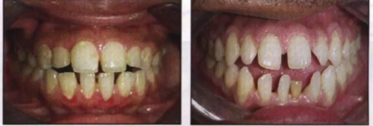 Gambar 16. Kasus Open Bite Anterior 