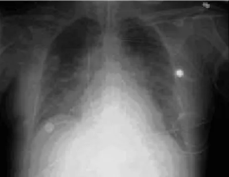 Gambar 2. Kardiomegali dan edema paru