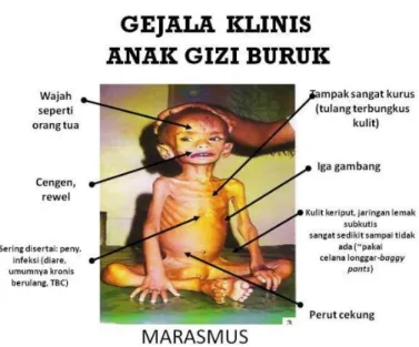 Gambar 3.2.1 Gejala Klinis dari Marasmus.