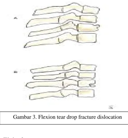 Gambar 3. Flexion tear drop fracture dislocation 