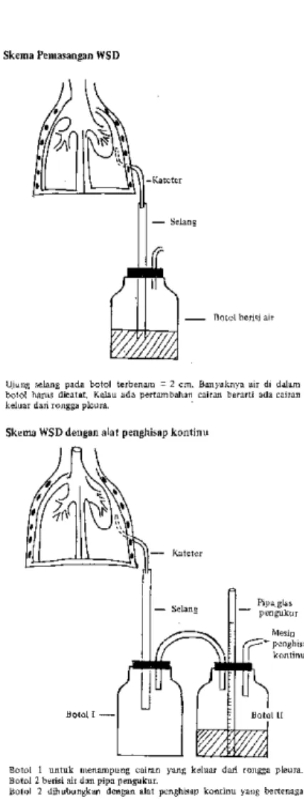 Gambar pemasangan WSD