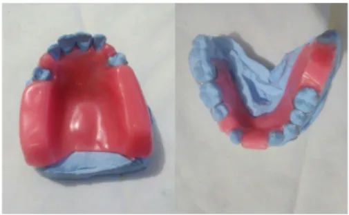 Gambar 3.10 Pembuatan bite oklusal rim