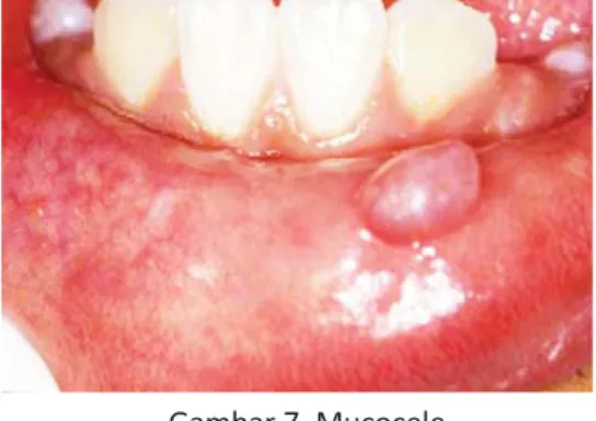 Gambar 7. Mucocele 