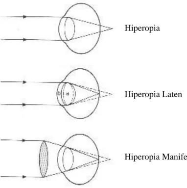 Gambar 13. Klasifikasi Hiperopia berdasarkan status akomodasi mata 
