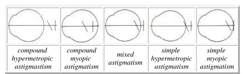 Gambar 14. Tipe-tipe Astigmatisme  Terdapat beberapa bentuk dari astigmatisme. 