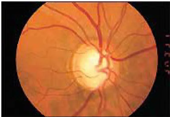 Gambar 2.6.5. Contoh gambaran funduskopi pada retina pasien glaukoma.