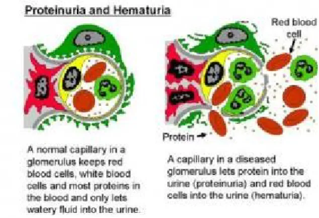 Gambar 7.proses terjadinya proteinuria dan hematuria