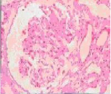 Gambar 8. Histopatologi gelomerulonefritis dengan mikroskop cahaya pembesaran 20×