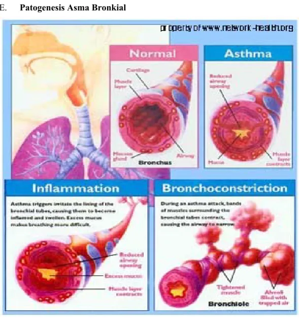 Gambar 1. asma terjadi karena penyempitan, peradangan dan konstriksi otot  bronkus 6