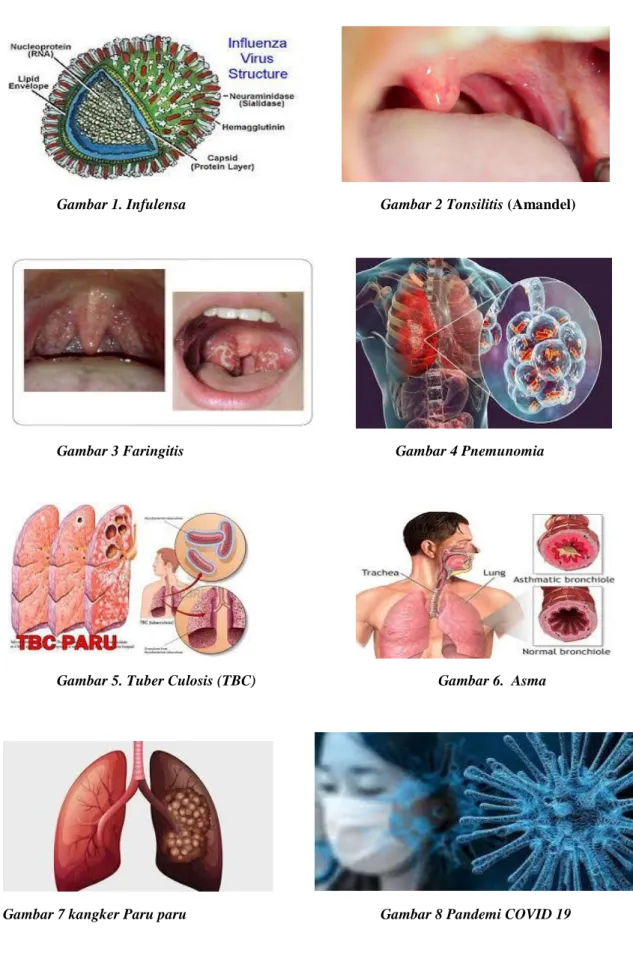 Gambar 1. Infulensa Gambar 2 Tonsilitis (Amandel) 