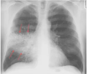 Gambar 1: Foto toraks PA pada pneumonia lobaris: tampak bercak-bercak  infiltrat pada paru kanan