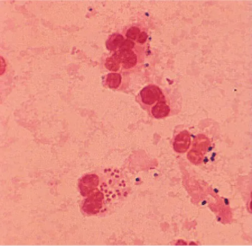 Gambar 2. Gonococcus dengan leukosit PMN (8) 2. Kultur (1.3)