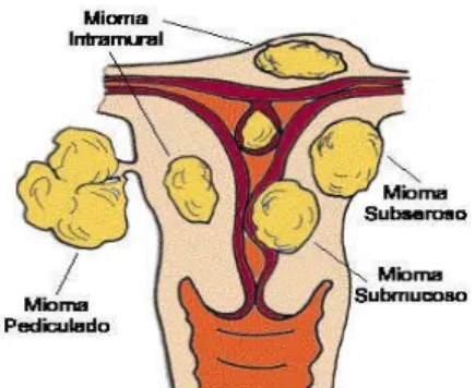 Gambar 1. Jenis-jenis mioma uteri. ( diunduh dari 