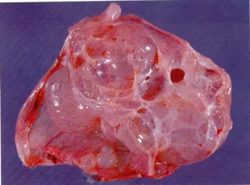 Gambar 2.5. Kistadenoma Musinosum  Sumber: Colour Atlas of Gynaecology 