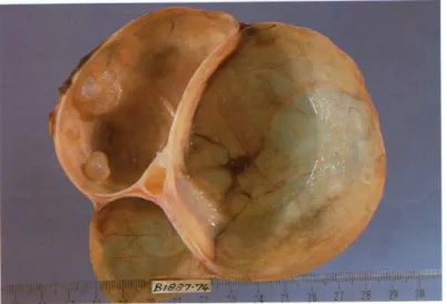 Gambar 2.6. Kista Ovari Serosum            Sumber: Colour Atlas of Gynaecology 