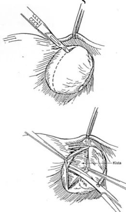 Gambar 2.10. Ovarial Kistektomi  Sumber: Dasar-dasar Teknik Operasi 