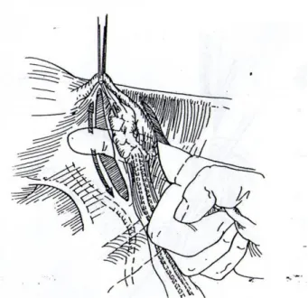 Gambar  sebuah  lubang  dibuat  pada  peritoneum  yang  telah  dilepaskan  sehingga  dengan  pasti  ligamentum  infundibulopelvikum dapat disisihkan Gambar 2.11