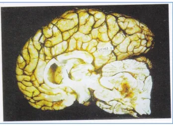 Gambar 9. Ependimoma  (Vinay Kumar dkk, 2007) 