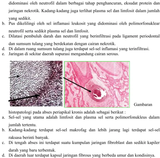 Gambar 2.5.3 Gambaran histologi abses periapikal akut (Sitanggang,2002)