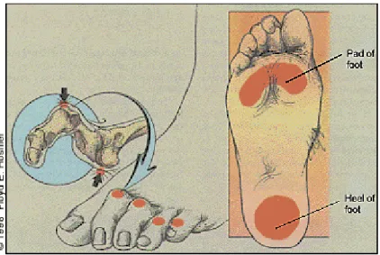 Gambar 1. Predileksi paling sering terjadinya ulkus pada kaki diabetik adalah bagian dorsal  ibu jari dan bagian proksimal &amp; dorsal plantar metatarsal