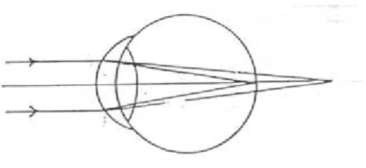 Gambar 1. Simple myopic astigmatism