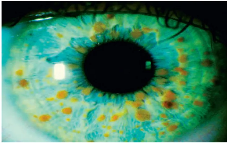 Gambar 2.2 : Lisch nodul pada iris mata
