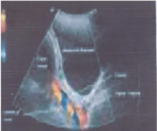 Gambar 6. Prolapsus tali pusat pada pemeriksaan colour doppler ultrasonografic  1